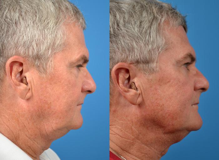 Laser Assisted Weekend Neck Lift Photos Melbourne, FL Patient 28545